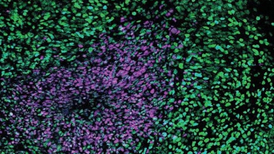 自閉症の原因となる遺伝子変異が脳の発達を乱す仕組みが判明